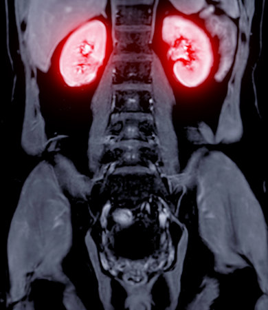 Magnetic resonance urography (MR urography) is a MRI study that predominantly used to image congenital abnormalities of the urinary system.の写真素材