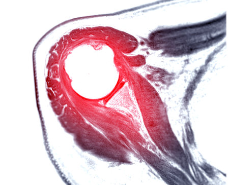 Magnetic Resonance Imaging or MRI of Shoulder Joint  for diagnostic shoulder pain.の写真素材