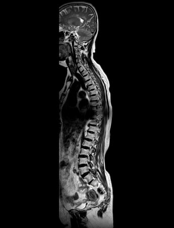 MRI whole spine screening for diagnosis spinal cord compression.の写真素材