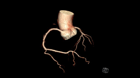 CT Cardiac 3D rendering  or CTA coronary artery for prevention coronary artery diseases.の写真素材