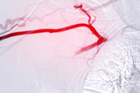 Image of Angioplasty, balloon angioplasty and percutaneous transluminal angioplasty (PTA) .の写真素材