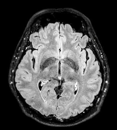 MRI  brain scan  Axial flair plane for detect  Brain  diseases sush as stroke disease, Brain tumors and Infections.の写真素材