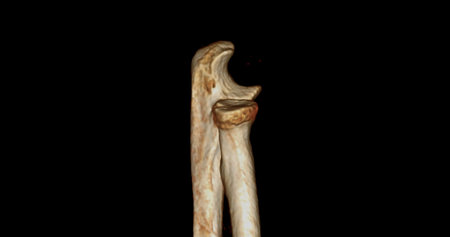 CT scan of elbow joint 3d rendering  showing ulna and radius bone.の写真素材