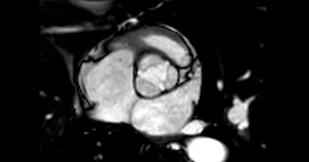MRI heart or Cardiac MRI ( magnetic resonance imaging ) of heart showing aortic valve .の写真素材