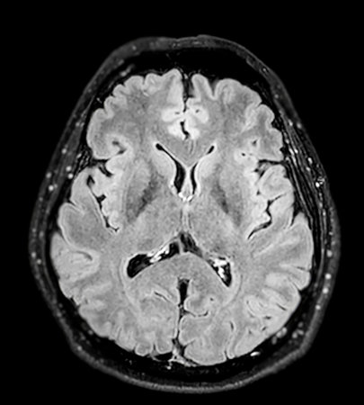 MRI  brain scan  Axial flair plane for detect  Brain  diseases sush as stroke disease, Brain tumors and Infections.の写真素材