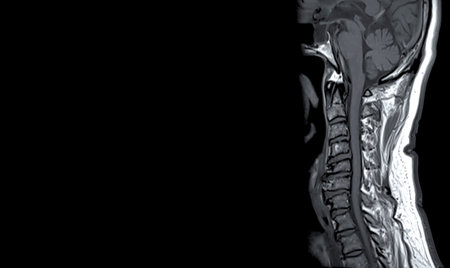MRI of  C-spine or magnetic resonance image of cervical spine  sagittal view  for diagnosis spondylosis and compression fracture.の写真素材