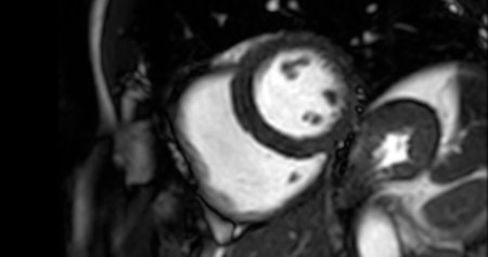 MRI heart or Cardiac MRI ( magnetic resonance imaging ) of heart in Short axis  view showing heart...