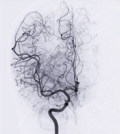 Cerebral angiography  image from Fluoroscopy in intervention radiology  showing cerebral artery.の写真素材
