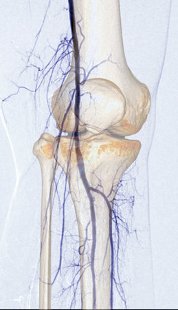 Femoral artery angiogram or angiography  at knee area.の写真素材