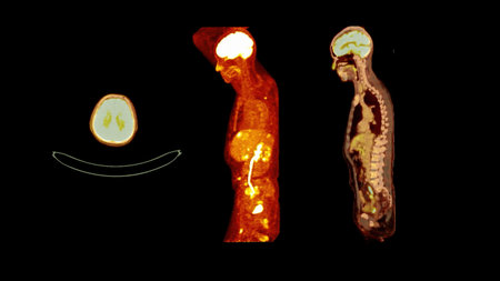 PET CT image of Whole human body  Axial ,coronal and sagittal plane. Positron Emission Computed Tomography .の写真素材