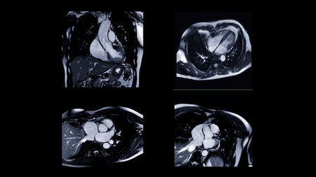 MRI heart or Cardiac MRI ( magnetic resonance imaging ) of heart  for detecting heart disease.の写真素材