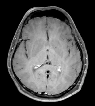 MRI  brain scan  Axial SWI  for detect  Brain  diseases sush as stroke disease, Brain tumors and Infections.の写真素材