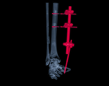 CT Scan ankle joint  3D  Rendering image showing fracture tibia and fibula bone with a plate and...