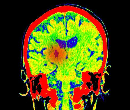 CT Brain Perfusion or CT scan image of the brain axial view  showing  cerebral blood flow on the...