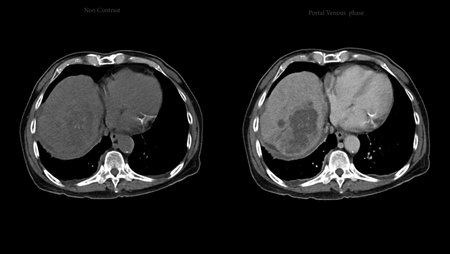 CT upper abdomen axial view  NC, A phase , V phase and delayed phase DDX is atypical HCC or hepatocellular carcinoma.の写真素材