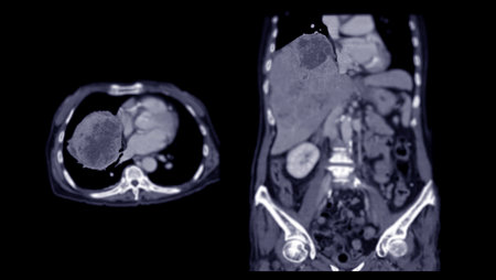 CT upper abdomen DDX is atypical HCC or hepatocellular carcinoma.の写真素材