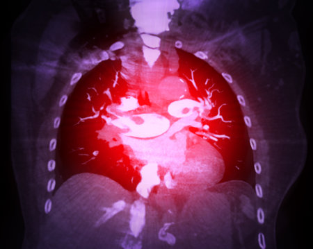 A CTA pulmonary artery reveals a detailed view of the lung blood vessels, capturing the presence of a pulmonary embolism, a condition where a blood clot disrupts normal blood flow.の写真素材