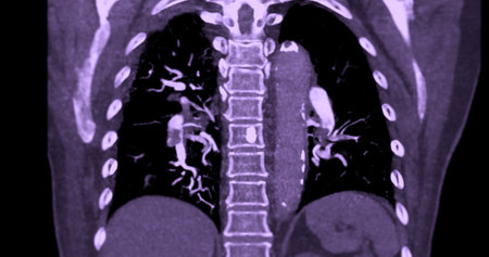 A CTA pulmonary artery reveals a detailed view of the lung blood vessels, capturing the presence of a pulmonary embolism, a condition where a blood clot disrupts normal blood flow.の写真素材