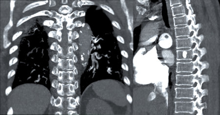 A CTA pulmonary artery reveals a detailed view of the lung blood vessels, capturing the presence of a pulmonary embolism, a condition where a blood clot disrupts normal blood flow.の写真素材