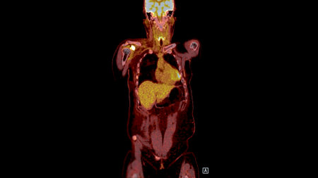 PET CT Scan fusion image It provides detailed images by merging metabolic activity from PET with...