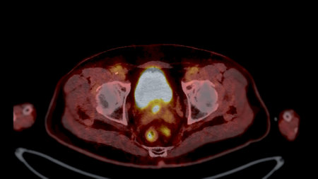 PET CT Scan fusion image It provides detailed images by merging metabolic activity from PET with...
