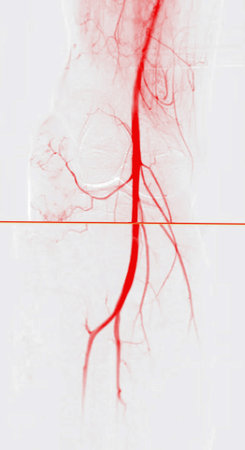 A Femoral Angiogram is a medical procedure used to visualize blood vessels in the groin area.の写真素材