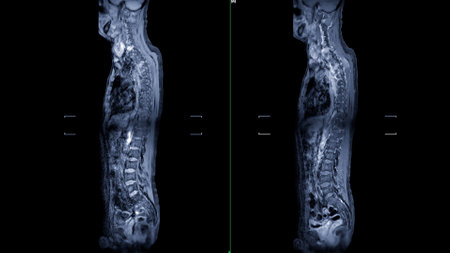 An MRI of the whole spine image is a comprehensive visual representation produced through Magnetic Resonance Imaging, providing detailed insights into the entire spinal structure.の写真素材