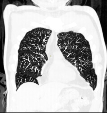 CT Chest Scan Overview  shows clear lung fields, heart, and mediastinum, providing a detailed view of the thoracic anatomy for medical evaluation.の写真素材