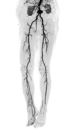 3D CTA of Lower Extremities:
A clear 3D visualization of the femoral artery and lower body skeleton, supporting vascular and orthopedic assessment.の写真素材