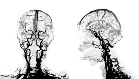 CTA Brain Imaging  shows a 3D brain CTA scan displayed on a tablet, with hands interacting for detailed vascular and neurological evaluation, isolation on white background, clipping path.の写真素材