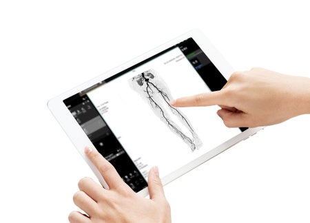 A detailed CTA scan of the femoral arteries is displayed on a digital tablet, with hands pointing to vascular structures, isolation on white background, clipping path.の写真素材