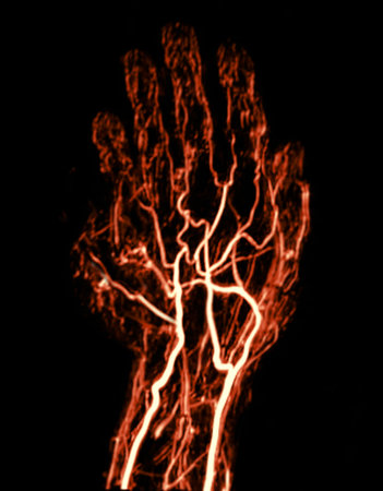 Hand Vascular Imaging via MRA:The MRA scan captures the detailed arterial structure of the hand,...