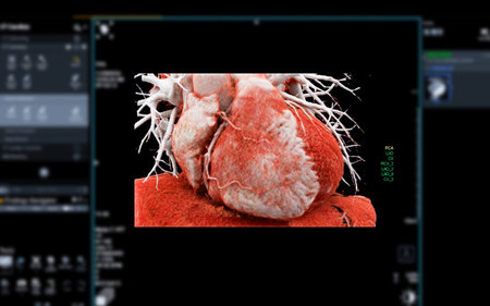 Realistic 3D Heart CTA Scan:
A detailed CTA scan showing the coronary arteries and heart structure, providing a comprehensive view for clinical evaluation.の写真素材