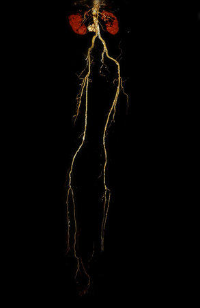 3D CTA of Lower Extremities:
A clear 3D visualization of the femoral artery and lower body skeleton, supporting vascular and orthopedic assessment.の写真素材