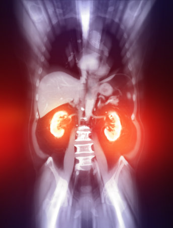 CTA Whole Aorta with Aortic Stent:
A clear visualization of the aorta in this CTA scan reveals stent placement, used to treat aneurysms or vascular abnormalities.の写真素材