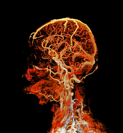 CTA Brain Vascular Imaging:
This image highlights a detailed 3D CTA scan of the brainâs vascular network, showing clear visualization of arteries and blood flow for diagnostic purposes.の写真素材
