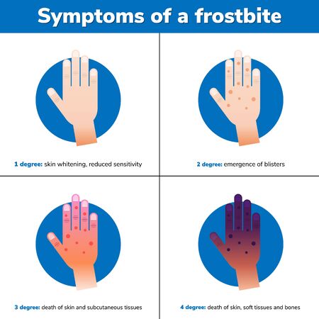 Simptoms of a frostbite. 4 medical stages. Infographic. Vector illustration.のイラスト素材