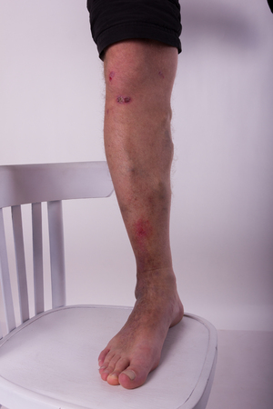 Mens diseased leg with phlebeurysm