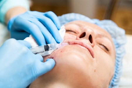 Beautician makes biorevitalization to young woman. The cosmetic procedures for the face. Beauty treatments in the spa salon. Facial Skin Care.の写真素材