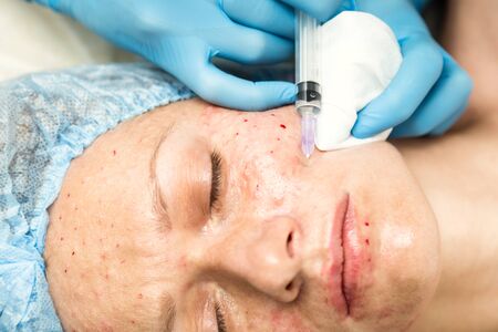 Beautician makes biorevitalization to young woman. The cosmetic procedures for the face. Beauty...