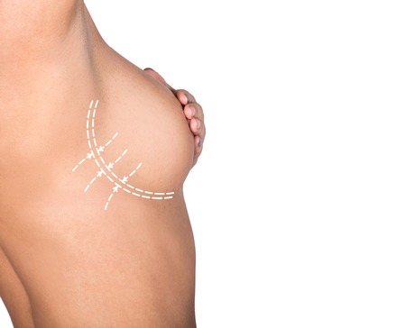 plastic or cosmetic surgery, cellulite correction, people and bodycare concept. female bust with lines. breast augmentation.の写真素材