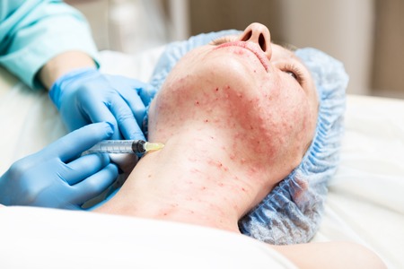 Beautician makes biorevitalization to young woman. The cosmetic procedures for the face. Beauty treatments in the spa salon. Facial Skin Care.の写真素材