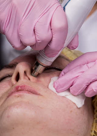 young woman with problem skin, mechanical deep face cleaning. beautician cleanses the womans skin with cosmetic equipmentの写真素材