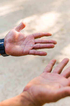 Athlete showing worn hands from intense calisthenics training
