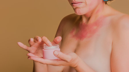 Woman with skin condition applying cream to chestの写真素材
