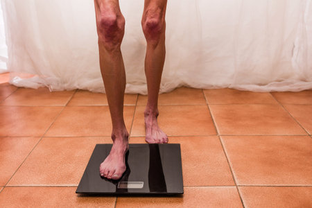 Woman with anorexia standing on bathroom scale