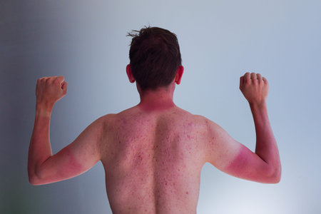 The guy burned in sun in city, the silhouette of t-shirt and watch. Reddened with acne skin on hands...
