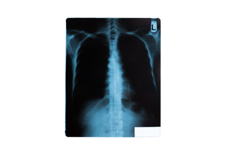 X-Ray Image Of Human Chest for a medical diagnosis