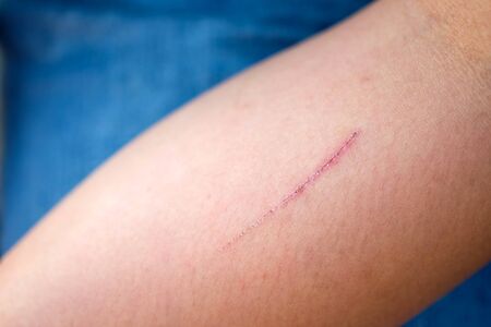 Wound in the arm of children.の写真素材
