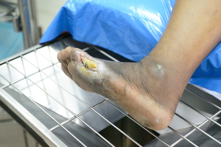 wound of diabetic foot 